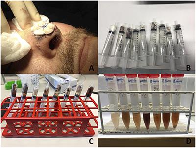 Inflammation Biomarkers and Correlation to Wound Status After Full-Thickness Skin Grafting